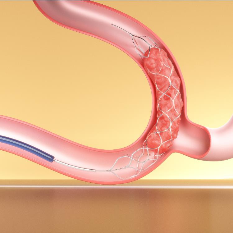 Stent Retrieval Thrombus Stent Retrieval Thrombus